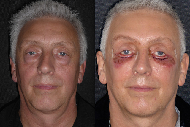 Alec, 52; Lower Eyelid surgery
Ectropion After Lower Blepharoplasty