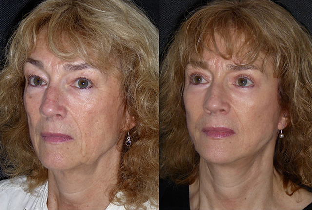 Dee 58 Facelift Neck Lift Eyelid Surgery Dominic Bray