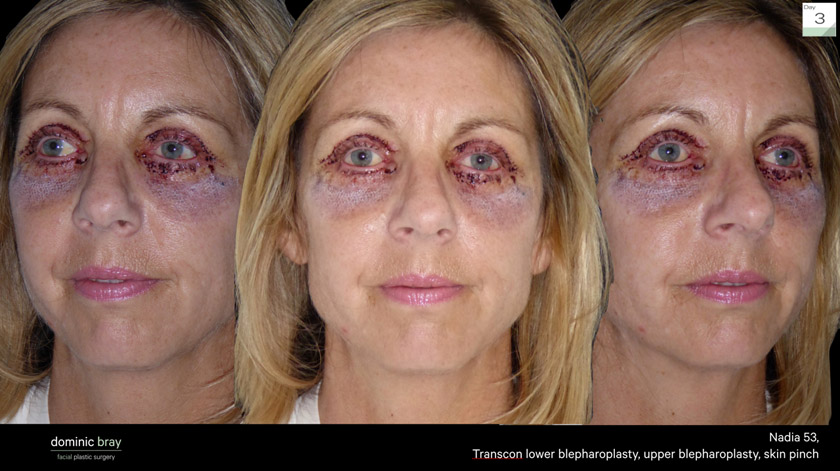 Nadia 53 Eyelid rejuvenation