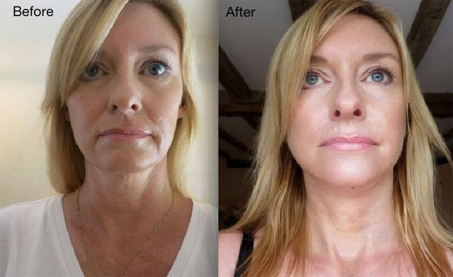 jo, 41 years old, facelift, testimonial