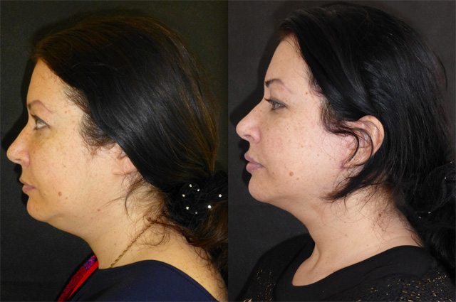 neck leila facelift ogee curve liposuction dominicbray