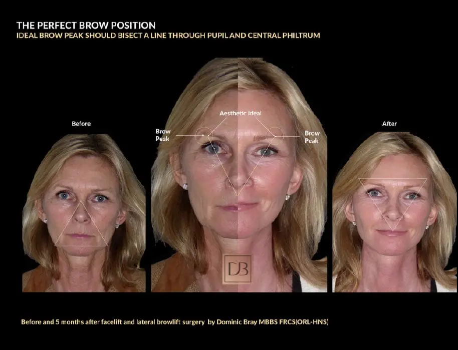 Brow Lift Treatment London