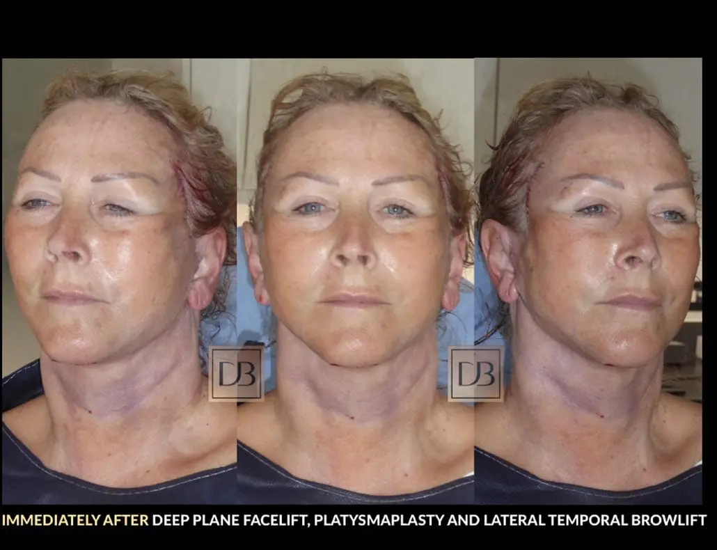 Facelift Recovery