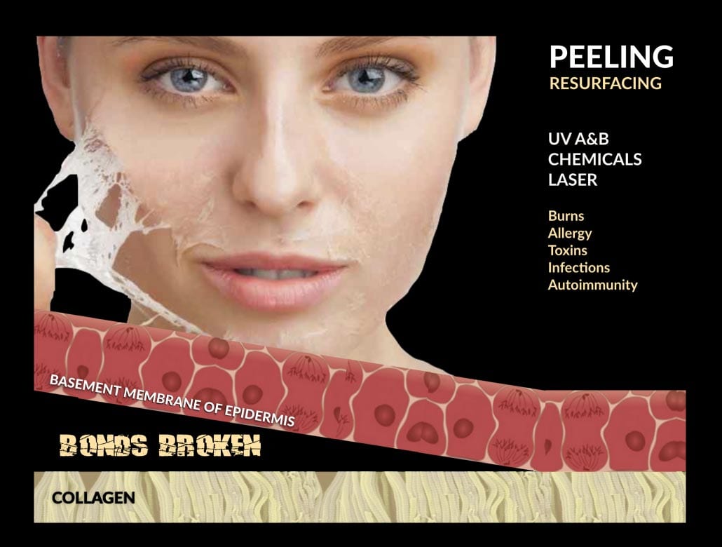 Peeling Resurfacing