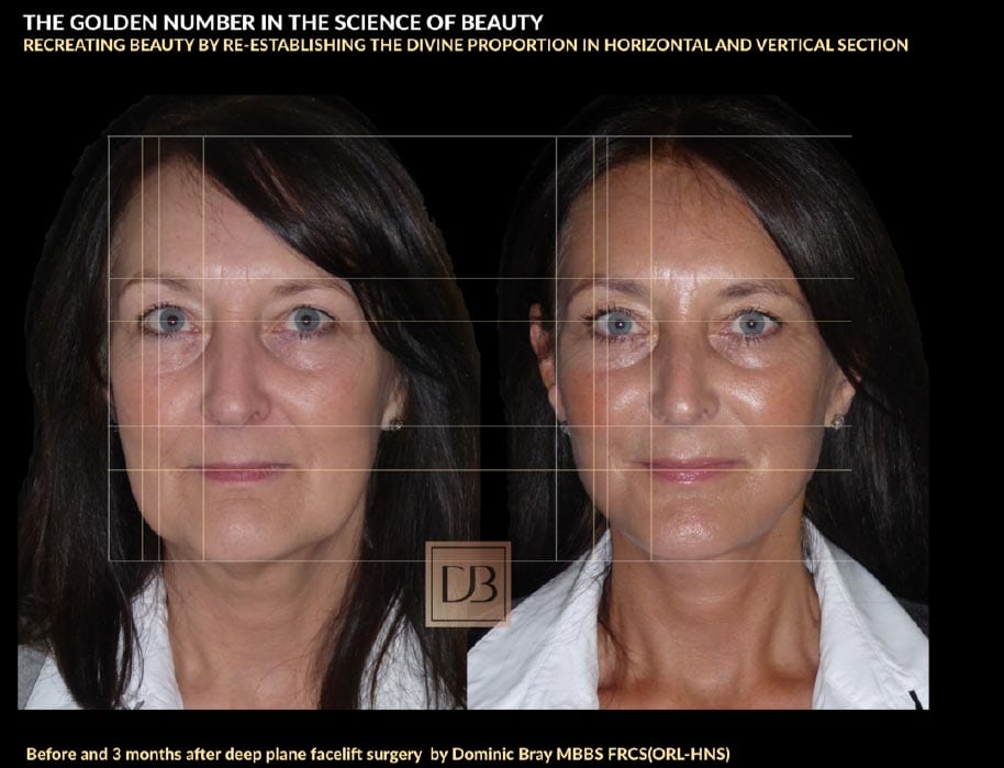 Before and 3 months after deep place facelift surgery