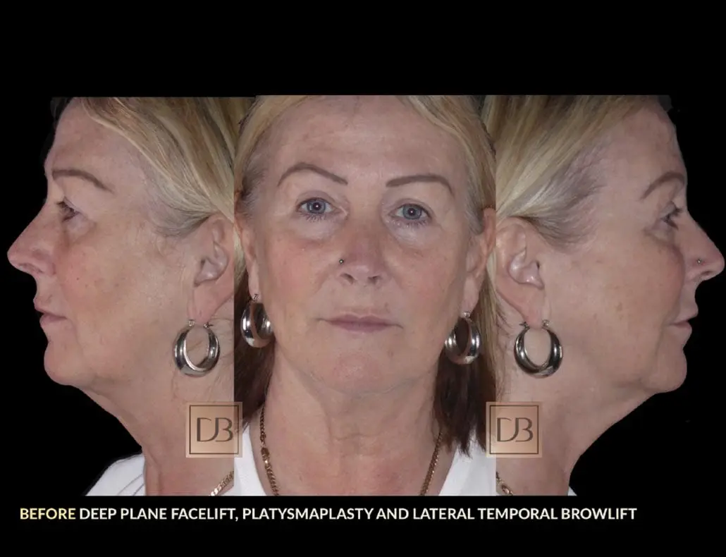 The Run Up To Your Facelift