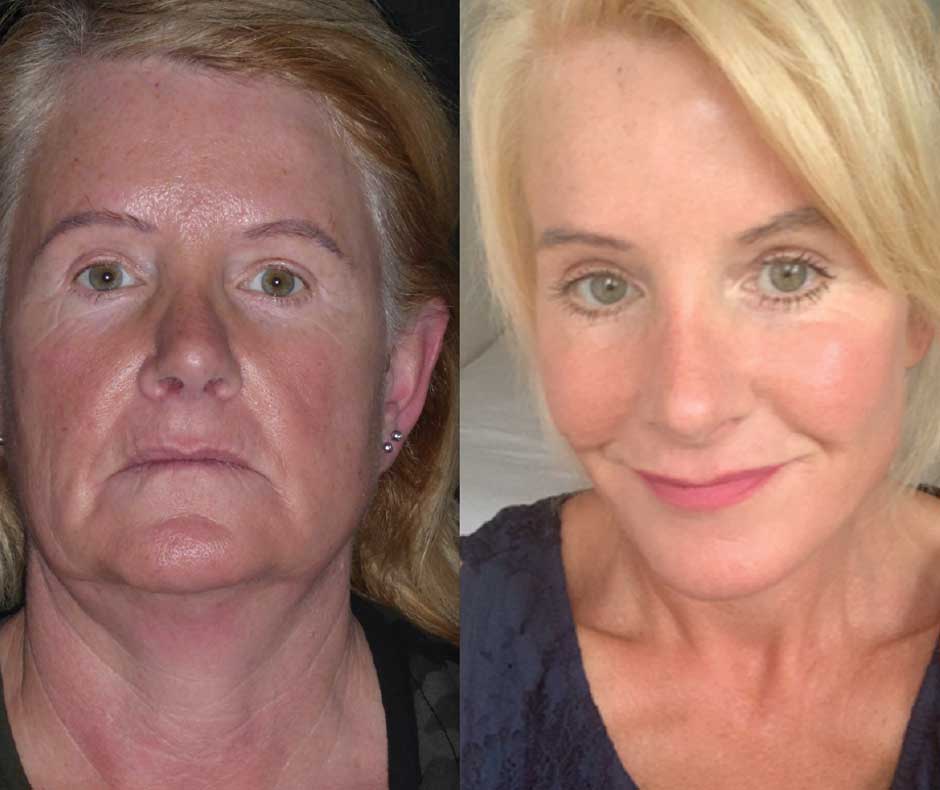 How facelifting ultimately affects / affect / life / approach