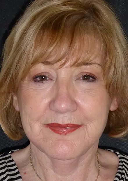 Annette, 63