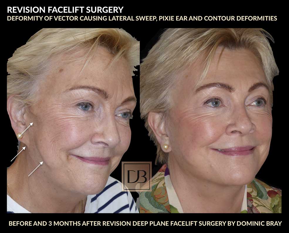 revision facelift surgery