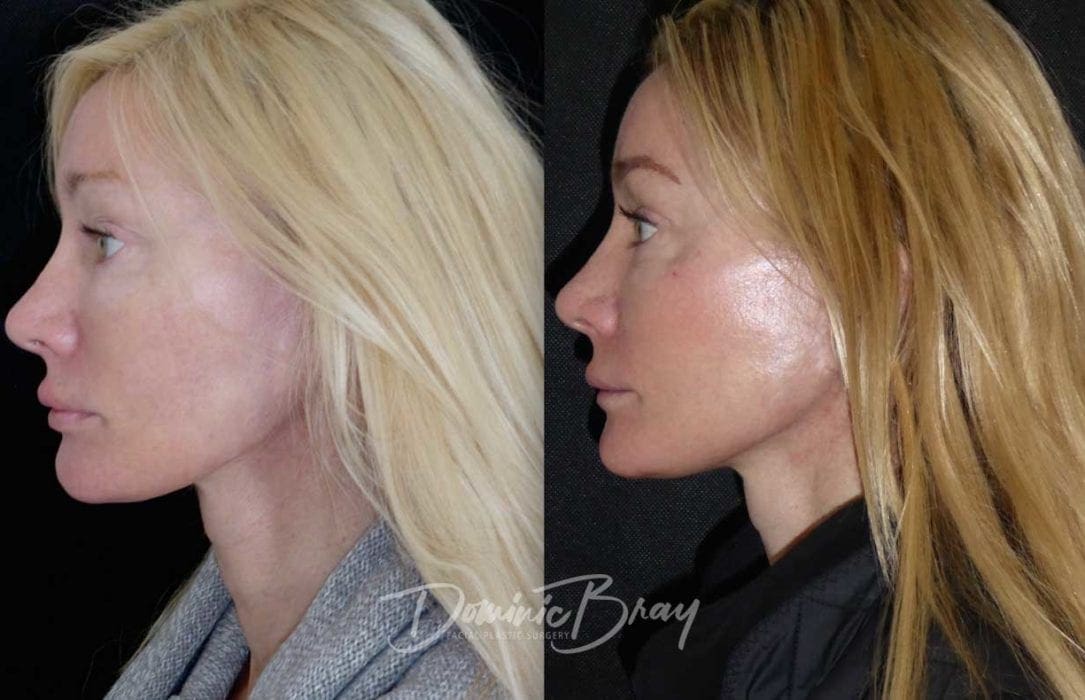 Plastic Surgery London The City's Leading Surgeon Dr. Dominic Bray Facelift Plastic