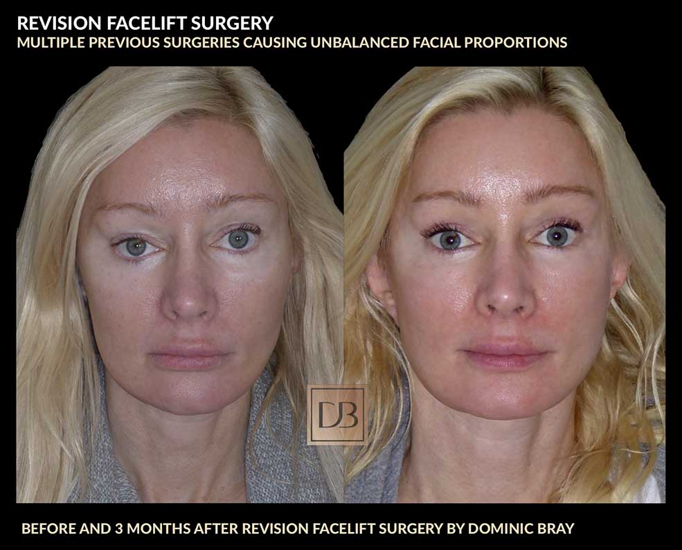 Multiple facial surgeries