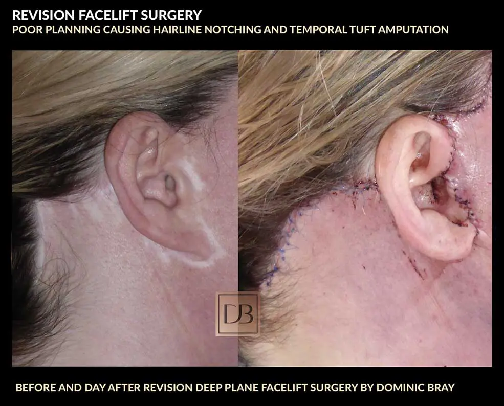 facelift revision